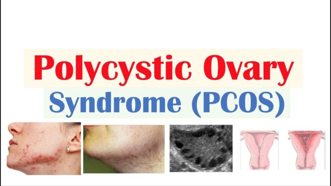 Polycystic Ovary Syndrome (PCOS): Signs, Trigger, and Remedy