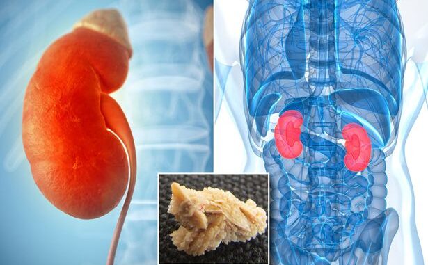 What trigger kidney stones and methods to eliminate it